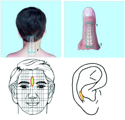 Reflexná terpaia projekčné zóny pri ochorení alebo úraze v oblasti krčnej chrbtice